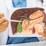 Fast Recovery After Laparoscopic Gallbladder Surgery in Mohali – Expert Care by Best Gallbladder Stone Surgeon